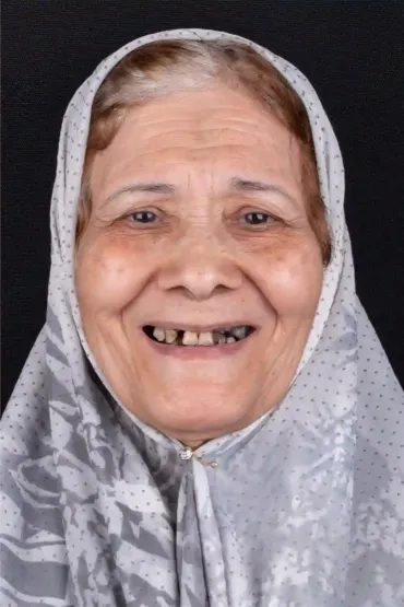قبل - کاشت ایمپلنت فول آرچ