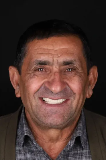 روکش موقت