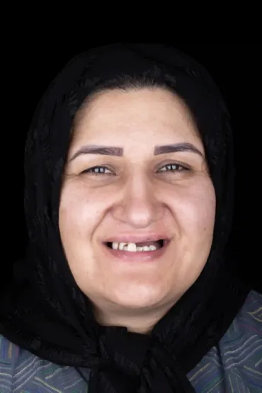 قبل - کاشت ایمپلنت فول آرچ