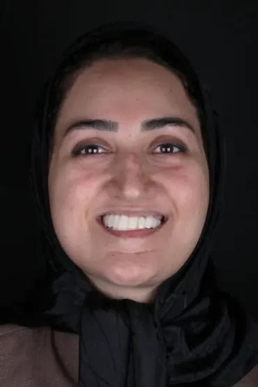 روکش موقت