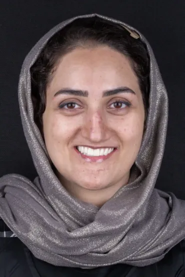 کاشت ایمپلنت فول آرچ - بعد